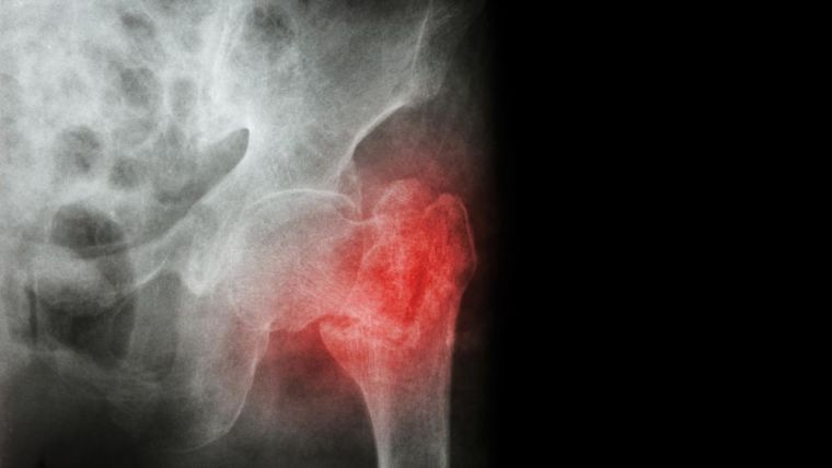 An xray image showing a hip fracture