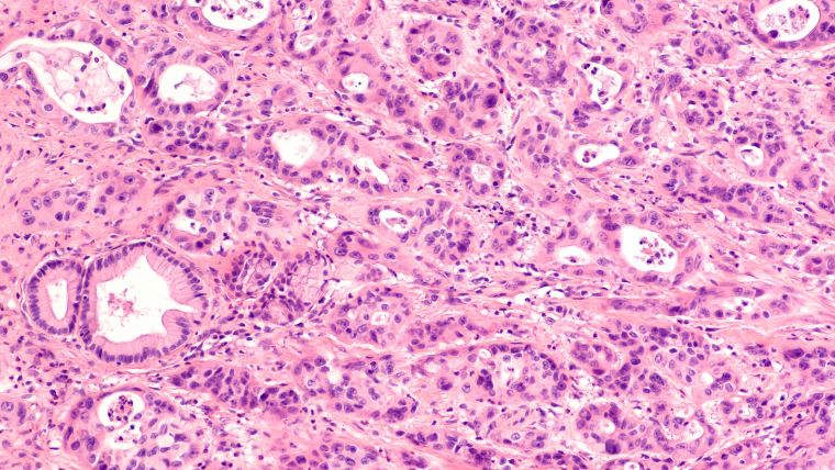 Pink image of cancer cells