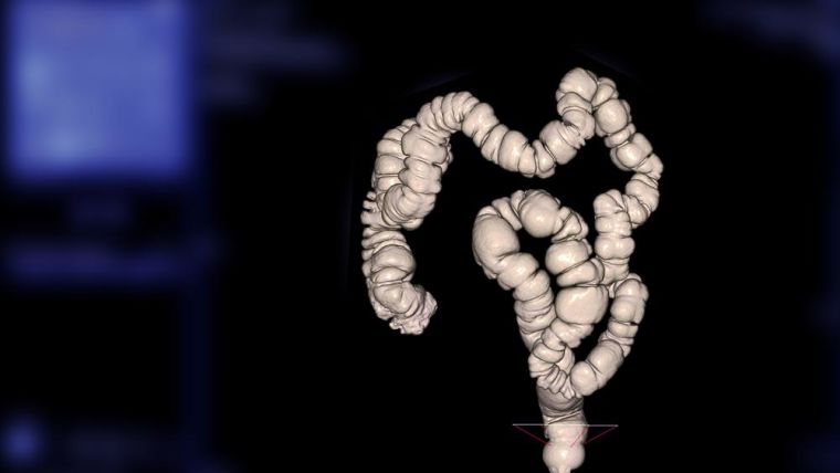 A Computed tomography Colonogrpahy scan - a 3d scan of a person colon
