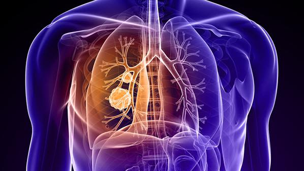 Lung cancer can be detected early by looking at common early symptoms, like cough.